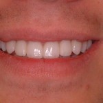 Kyle-Smile-after Kyle-Smile-after-tellman dentistry