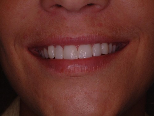 Marty-Schro-Before-Smile-150x150 tellman dentistrey Marty Before