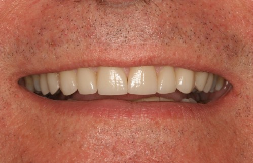 craigs new smile Craigs dental work by tellman dentistry
