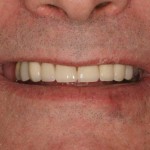 Lous new smile large lous dental work tellman dentistry