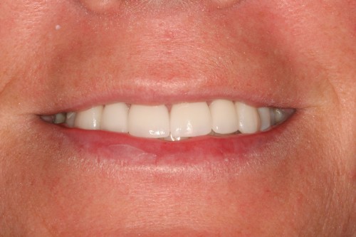 Melissa-Smile-before Melissa dental work by tellman dentistry
