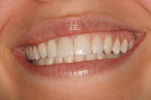 new-porcelian-crown-before-large porcelian crown work tellman dentistry before