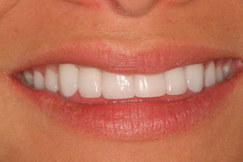 starlas new smile large Starlas dental work by tellman dentistry